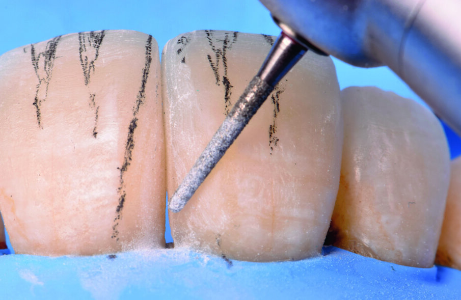 Fig 16. Anatomical contouring of Mesial Line Angles with Fine Diamond Point