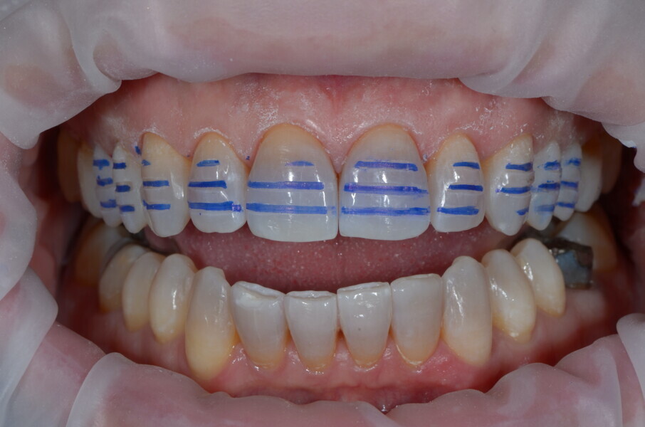 Fig. 6: Clinical preparation according to the mock-up.