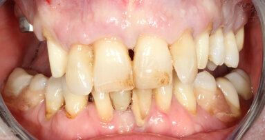 Partial extraction therapy and implant treatment in the maxilla