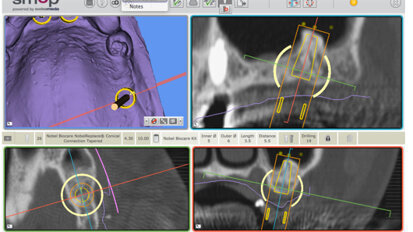 La chirurgie guidée pour optimiser l’implantologie