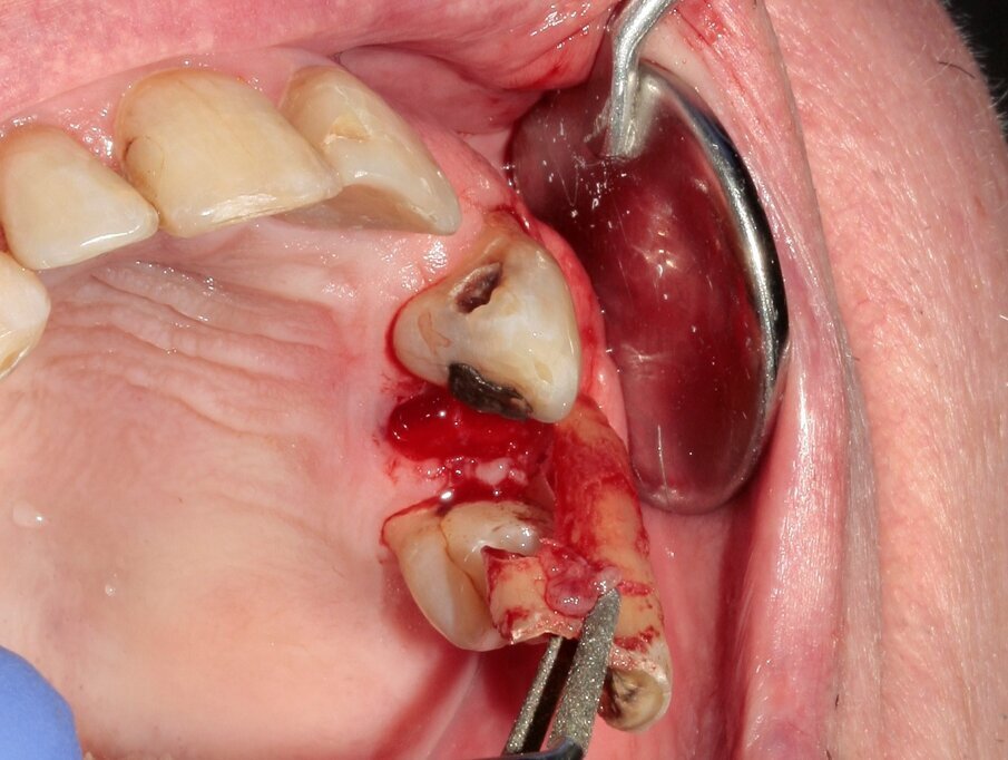 Fig. 8: The tooth was removed with the help of diamond tweezers.