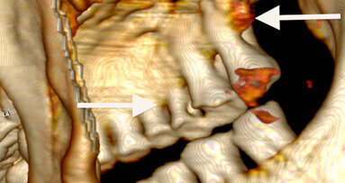 Eismumie Ötzi auf den Zahn gefühlt