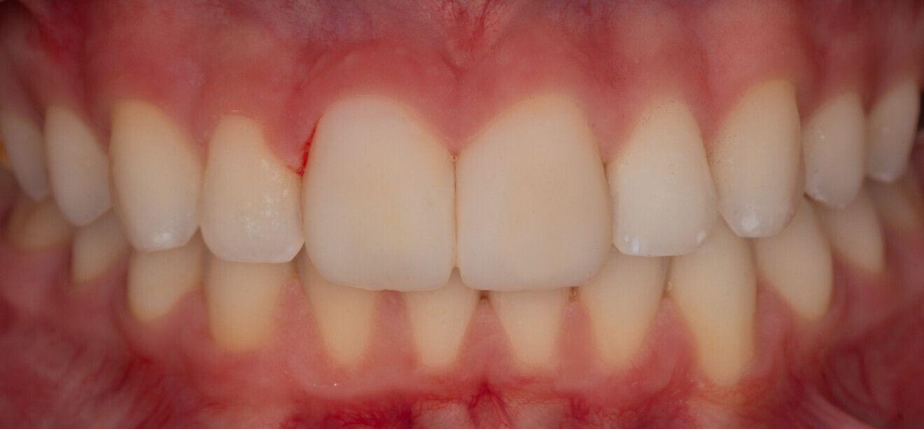 Fig.23 : Résultat en lumière polarisée (Polar Eyes Emulation) permettant le contrôle du résultat colorimétrique des facettes par rapport aux dents adjacentes.