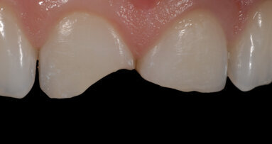 Un nuevo concepto en la estratificación con resinas compuestas