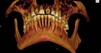 Mummie met gebit vol caviteiten ontdekt