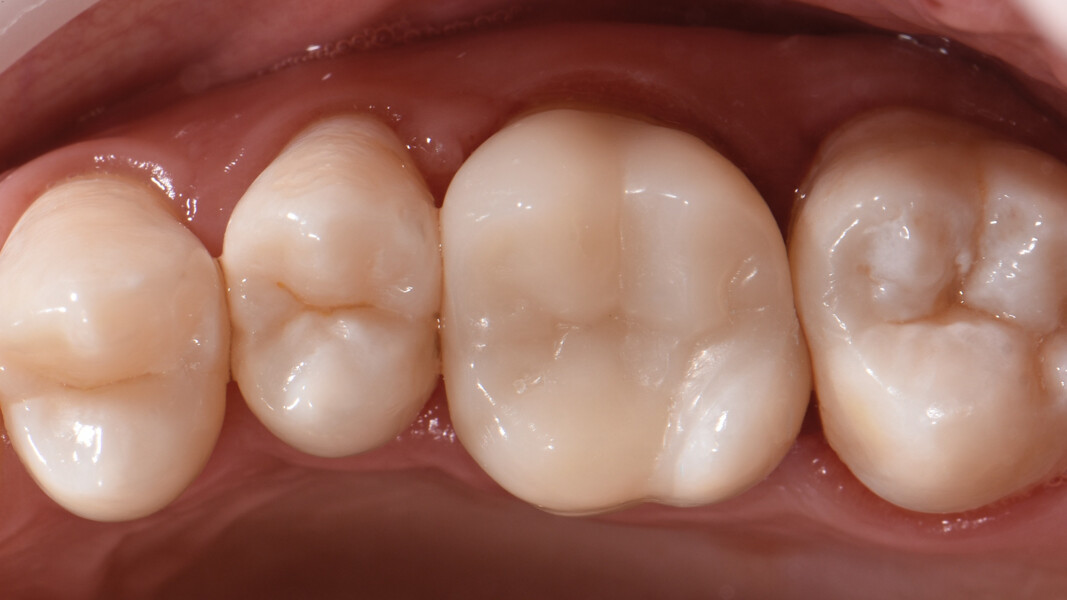 Fig. 30: Immediate postoperative appearance after dental dam removal.