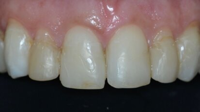 Riabilitazione estetica-funzionale del settore anteriore tramite full-veneers