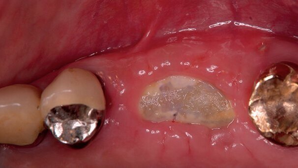 Procedure mininvasive d’aumento e preservazione alveolare (open barrier membrane technique)