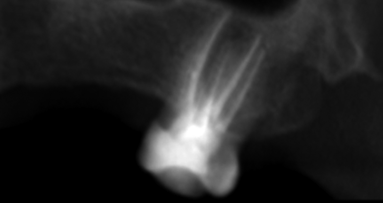 Diagnosis and management of a rare case of a maxillary second molar with two palatal roots - Supported by conventional radiography and CBCT