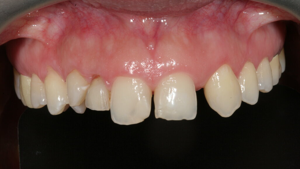 Tratamientos provisionales perfectos