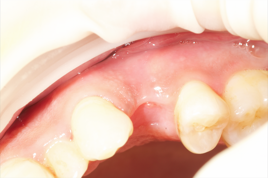 Fig. 11 - Situazione due settimane dopo: buona guarigione senza interferenze da parte del biomateriale.