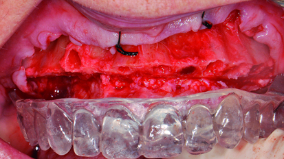 An indirect method for provisionalisation: The team approach in a complete mouth hybrid reconstruction