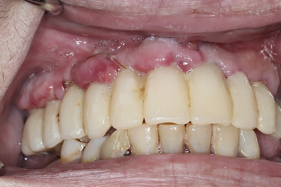 Fig. 5d: Provisional restoration placed over the graft and platelet-rich fibrin after suturing.