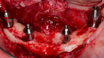 Impianti sotto-crestali GTB e impianti zigomatici per la riabilitazione dei mascellari atrofici