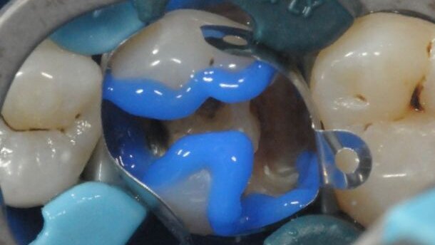 Behandeling van een falende restauratie 26 met behulp van SDR en Ceram-X Universal