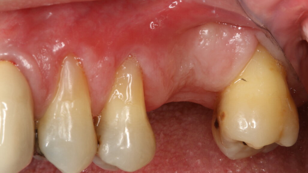 Biomateriali innovativi in implantologia: l’utilizzo di OsteoBiol Putty nel rialzo di seno transcrestale