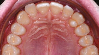 Risoluzione dell’affollamento mediante F22 Aligner