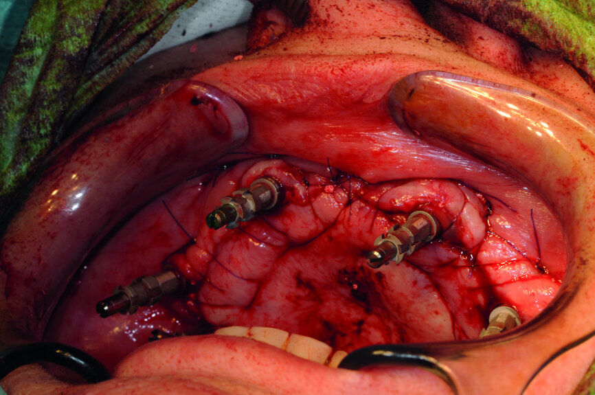 Cas 1c : Les sutures sont réalisées à deux niveaux : des points en matelassier apicaux afin de « fixer » les lambeaux, puis des points séparés et (ou) un surjet afin de stabiliser ces lambeaux