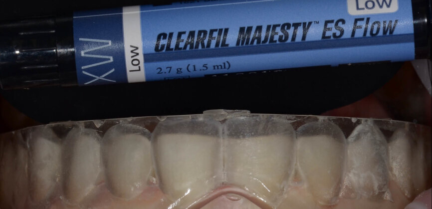 Fig. 4: For this case, it was decided to use CLEARFIL MAJESTY ES Flow Low in Shade XW (Kuraray Noritake Dental), the properties and flowability of which made it ideal for a case like this. 