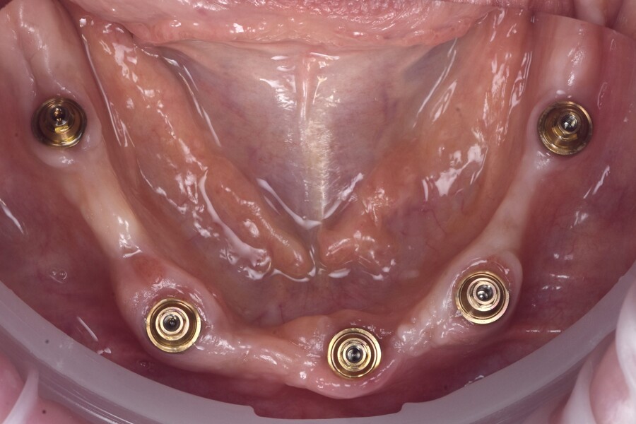 Fig. 10: Multi-unit abutments after five months of healing.