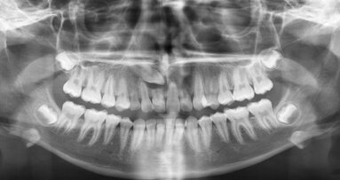 Preservación del tejido gingival en la rehabilitación implanto protésica postortodóncica