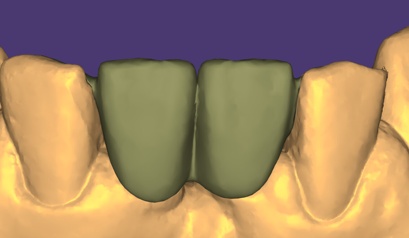 Fig. 4: Design of the new bridge using exocad software (via the design4me platform).