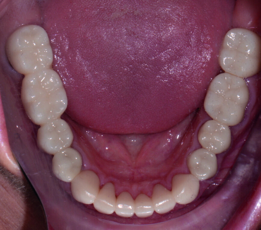 Fig. 12: Post-op retracted view.