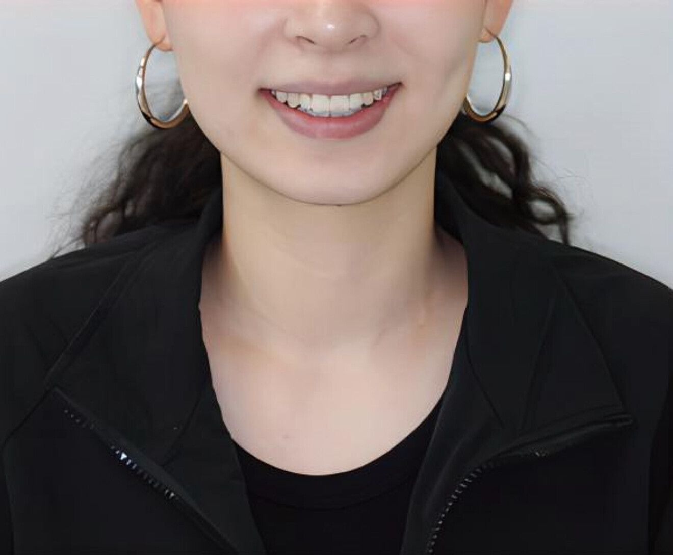 Fig. 4a: Post-treatment situation. Frontal facial view.