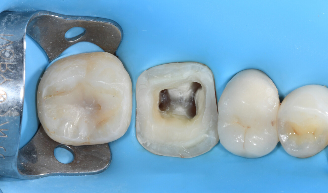 Fig. 3: Tooth #46 after caries removal, margin elevation and refinement of the cavity preparation for the planned endocrown.
