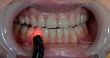 Biostymulacja laserem diodowym 635 nm w leczeniu nadwrażliwości
