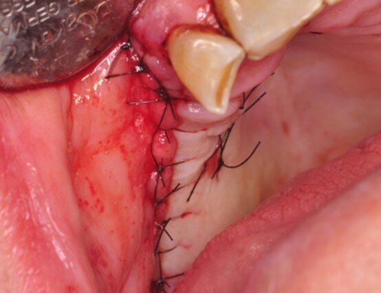 Ryc. 5_Śródzabiegowo: stan po zamknięciu płata.