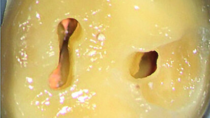 Préparer les cavités d’accès endodontique – Pour des résultats à long terme