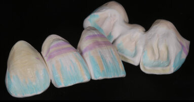 The dream team: Effect liquids and micro-layering on highly aesthetic zirconia