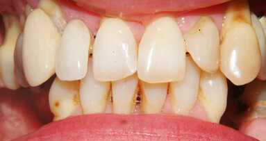 Periodontitis, Diabetes and Smoking