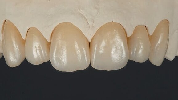 Cementation of zirconia