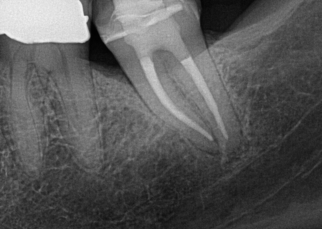 The post-op radiograph shows the tooth after endodontic preparation with HyFlex EDM OGSF files, ensuring gentle cleaning in complex canal anatomy, and obturation. (Image: Dr Sabine Remensberger) 