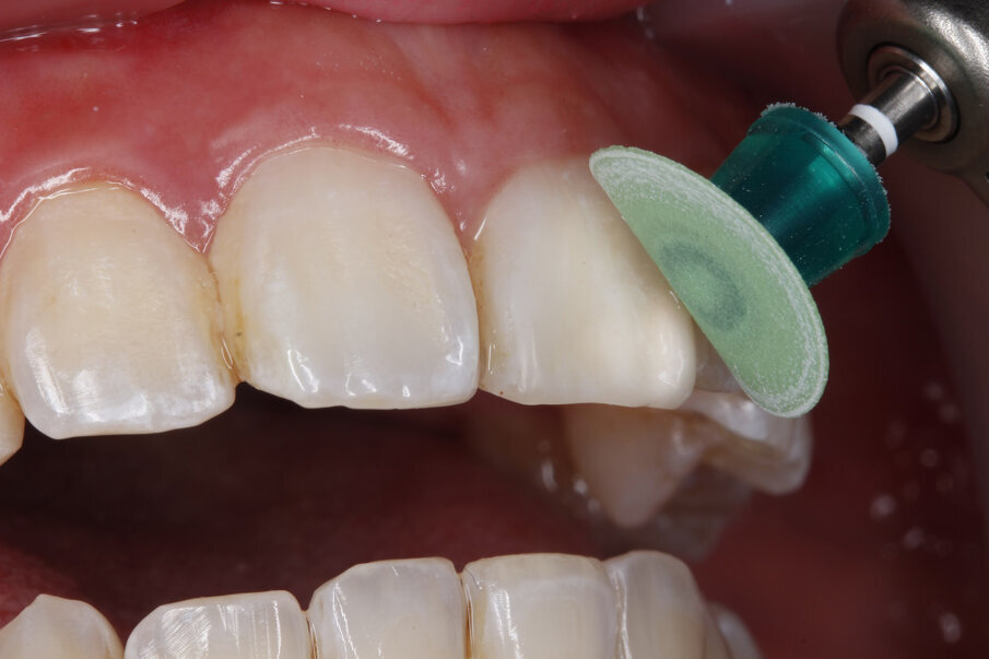 Fig 11: Polishing with Super-Snap Xtreme green disk