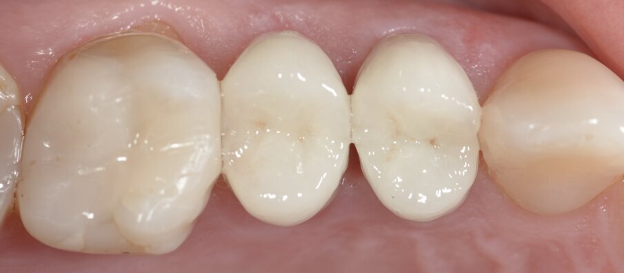 Fig. 6: Situazione postoperatoria dopo due mesi.
