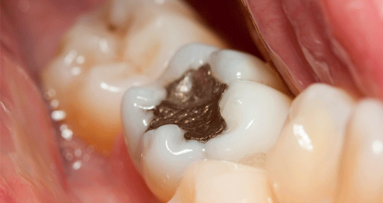 Kontra Amalgamverbot