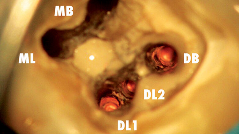 Dentální operační mikroskop v endodoncii