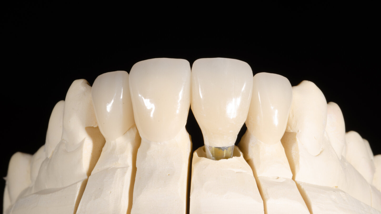 Anterior crowns on teeth and an implant
