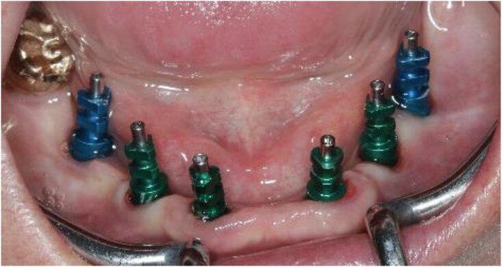 Fig. 11: Frontal view showing the screw-retained posts at impression taking 24 weeks after implant placement.