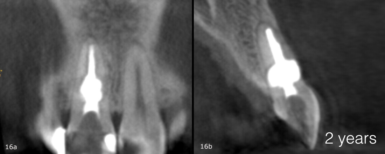 Figs. 16a & b: CBCT scan taken two years after the treatment.