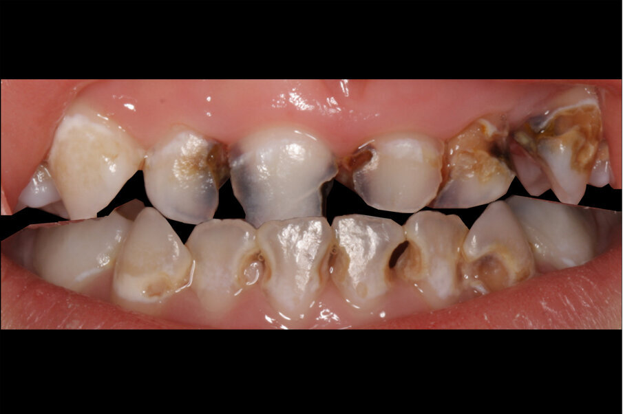 Afbeelding 3. Casus 2: 29-09-17. Eerste bezoek. Actieve cariës-instructies en ZDF aangebracht.