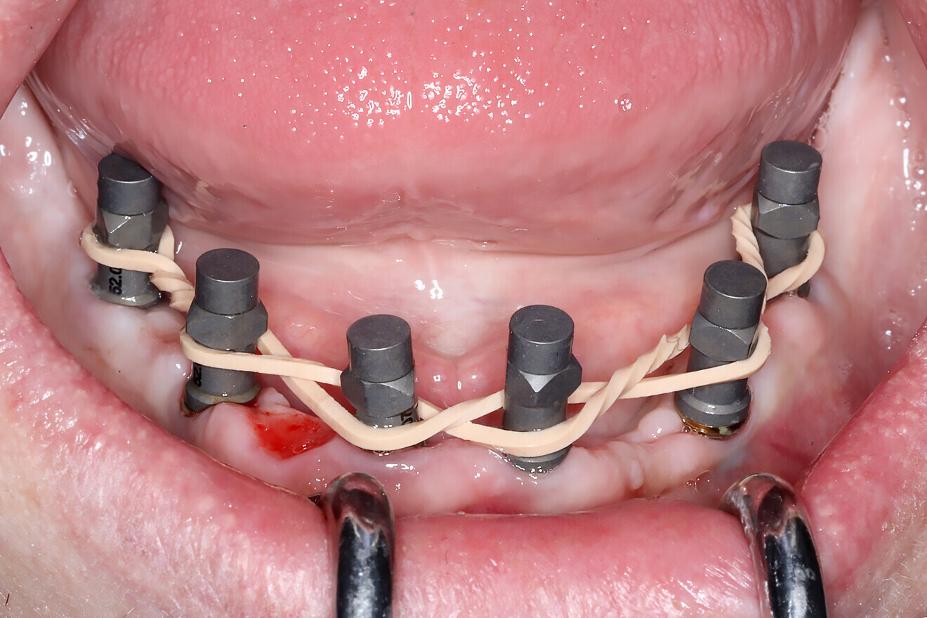 Figs. 1a–c: Rubber bands (a & b) or composite applied directly to the tissue (c) to aid intra-oral scanners in acquiring accurate data.