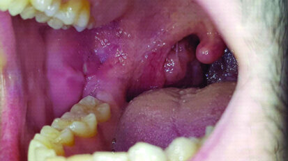 Lesioni orali trattate con un particolare olio ozonizzato (Ialozon): 2 case report