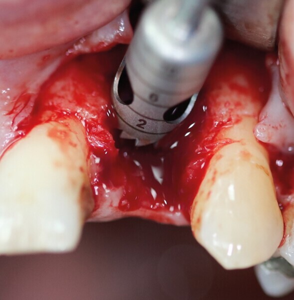 Fig. 21 : Passage d‘un trépan. 