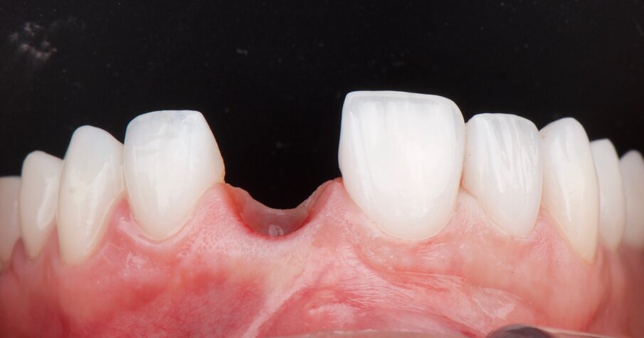 Fig. 23: Four months after healing, the gingiva was healthy and showed excellent buccal volume coincident with the adjacent central incisor.