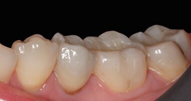 El espectrofotómetro en la estética dental