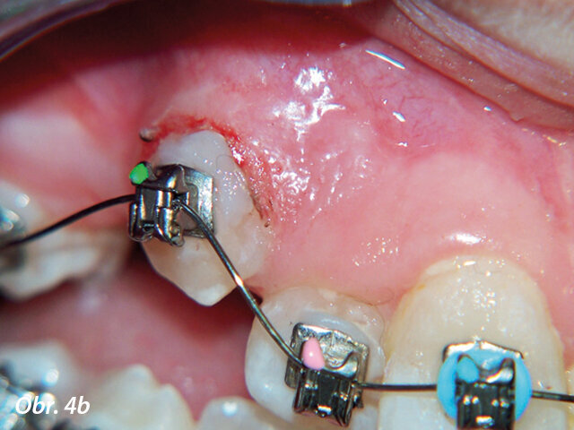 Gingivoplastika kvůli optimálnímu umístění zámku.